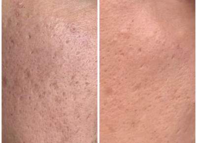 Dermapen