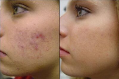 Dermapen