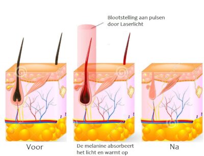 Laserontharing