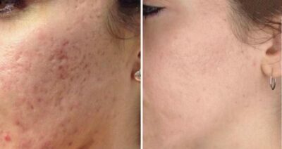 Fractional Laser (littekentherapie)