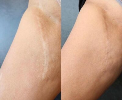 Fractional Laser (littekentherapie)
