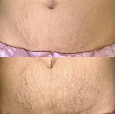 Fractional Laser (littekentherapie)