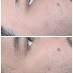 CO2 Fractional Laser