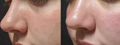 HydraFacial
